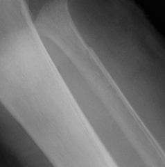 Ankle Fracture Maisonnerve Proximal Fibula